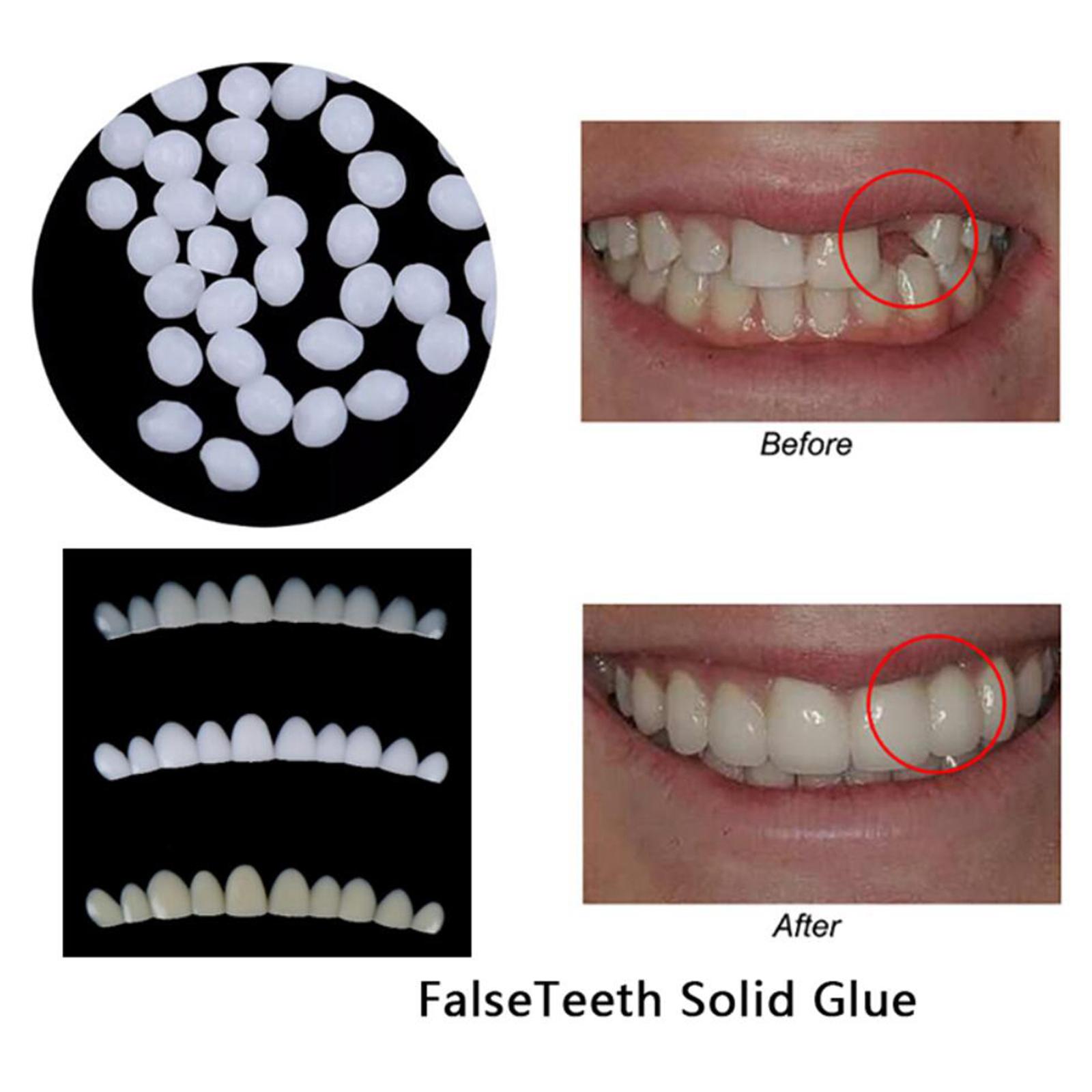 Temporary Teeth Whitening Kit  - đánh giá và giá Teeth Whitening At Home Kit