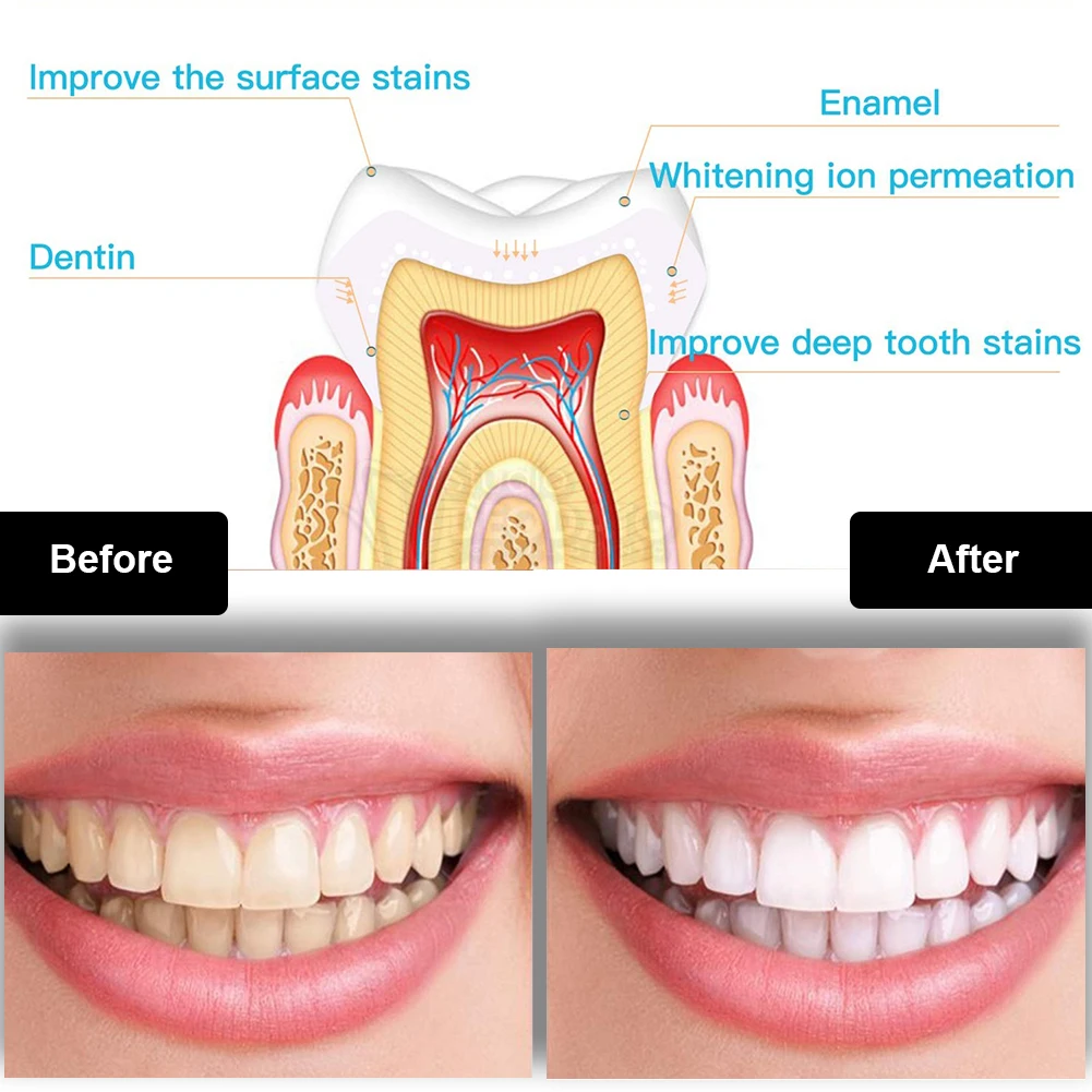 Dental Teeth Whitening Kit Min - đánh giá và giá Teeth Whitening Bleaching Kit