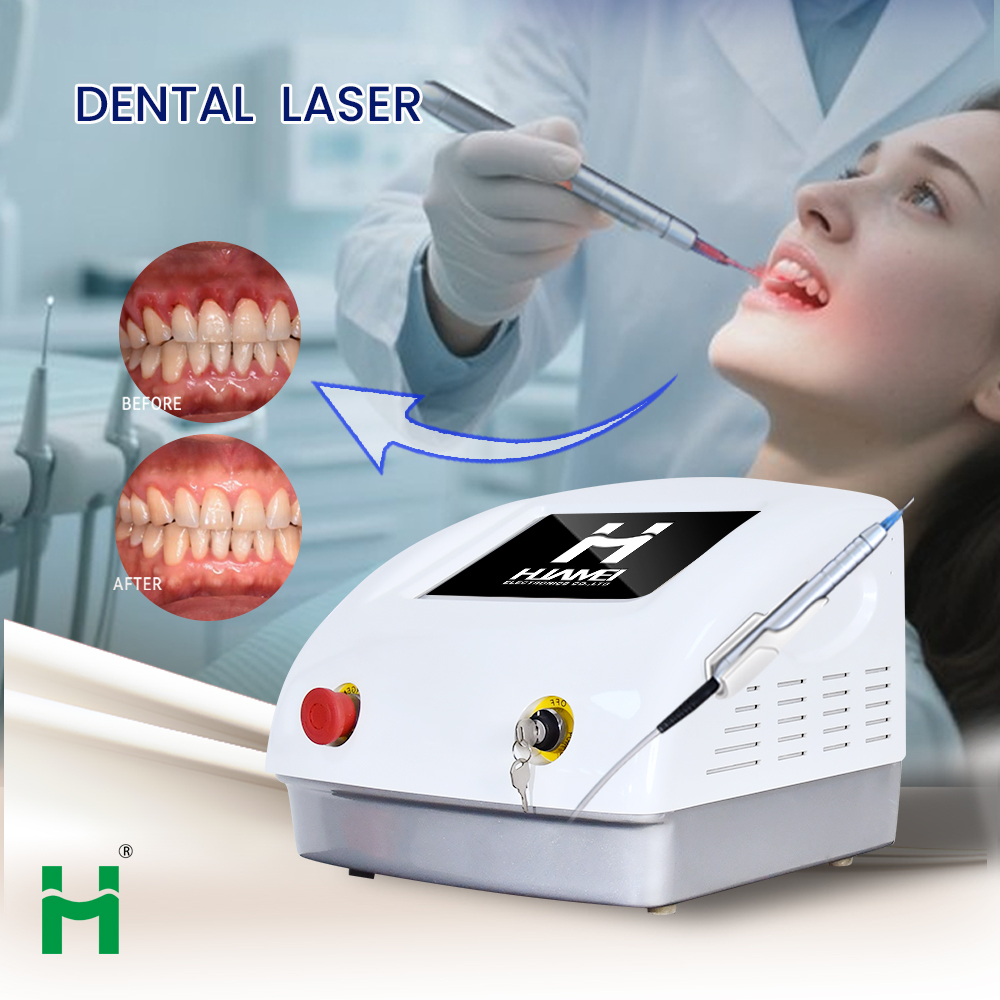 Portable LED Teeth Whitening K - đánh giá và giá Teeth Whitening Bleaching Kit